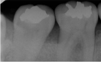 原因歯の特定